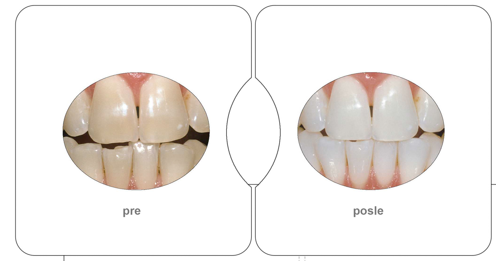 Izbeljivanje zuba, pre i posle