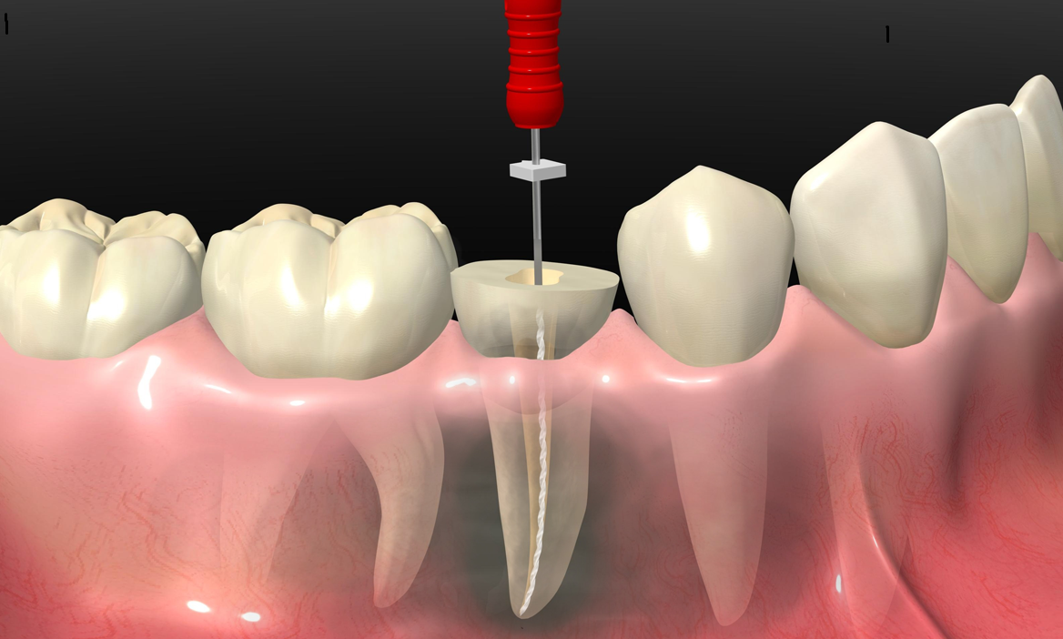endodontski tretman zuba