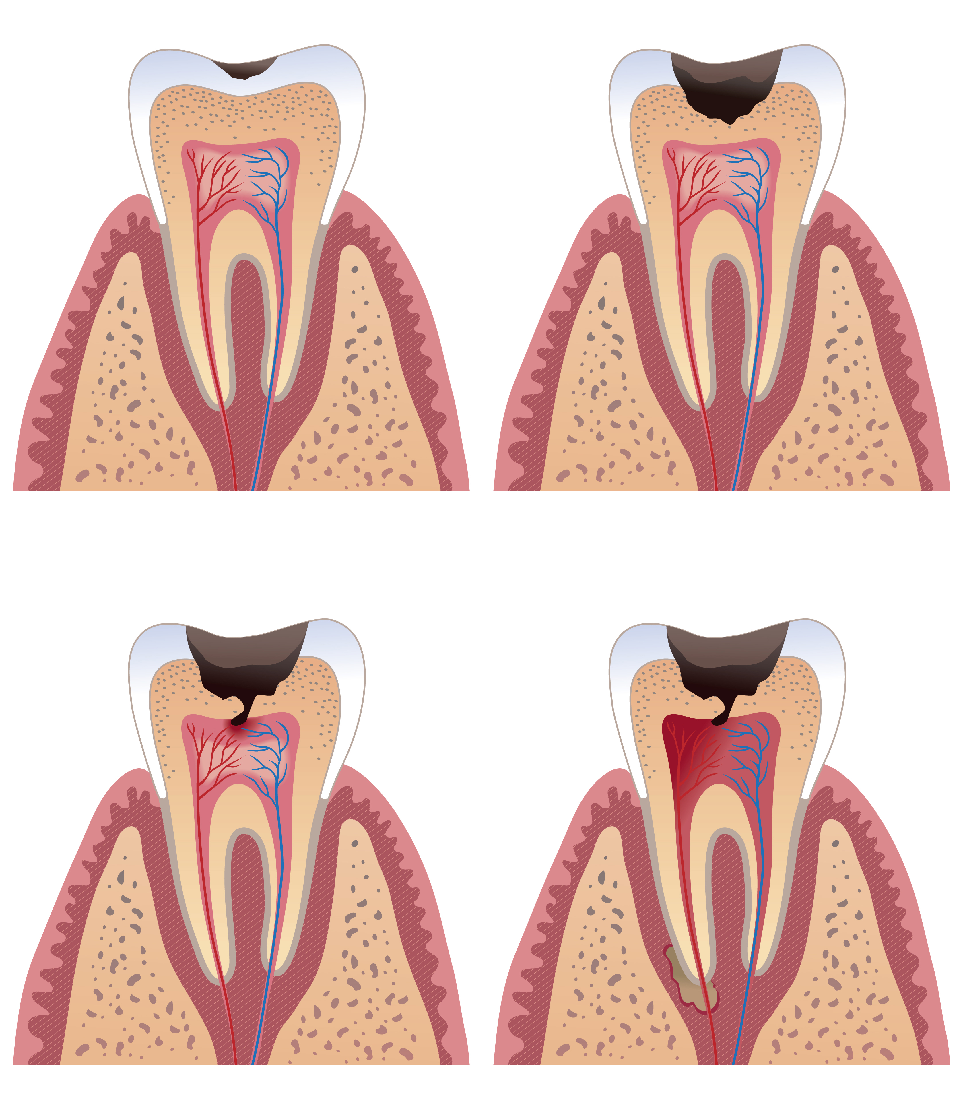 TREATMENT OF DEEP CARIES LESIONS