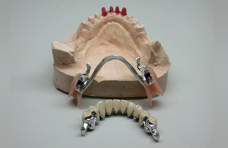 COMBINED FIXED-MOBILE PROSTHETIC RESTORATIONS