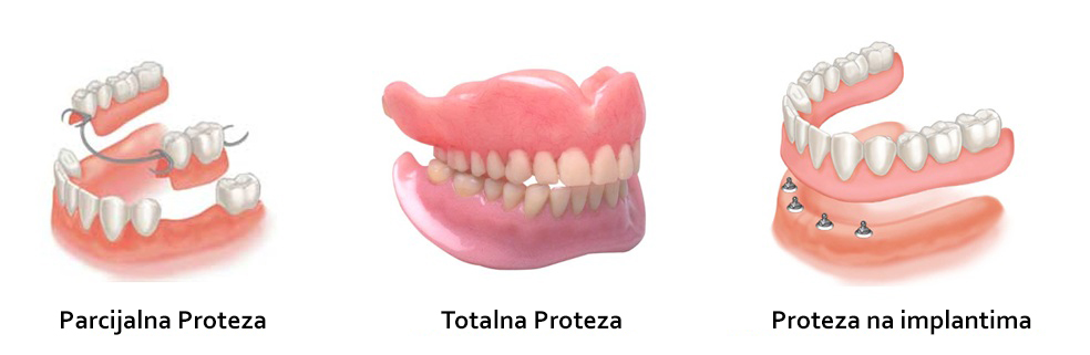 Parcijalna zubna proteza